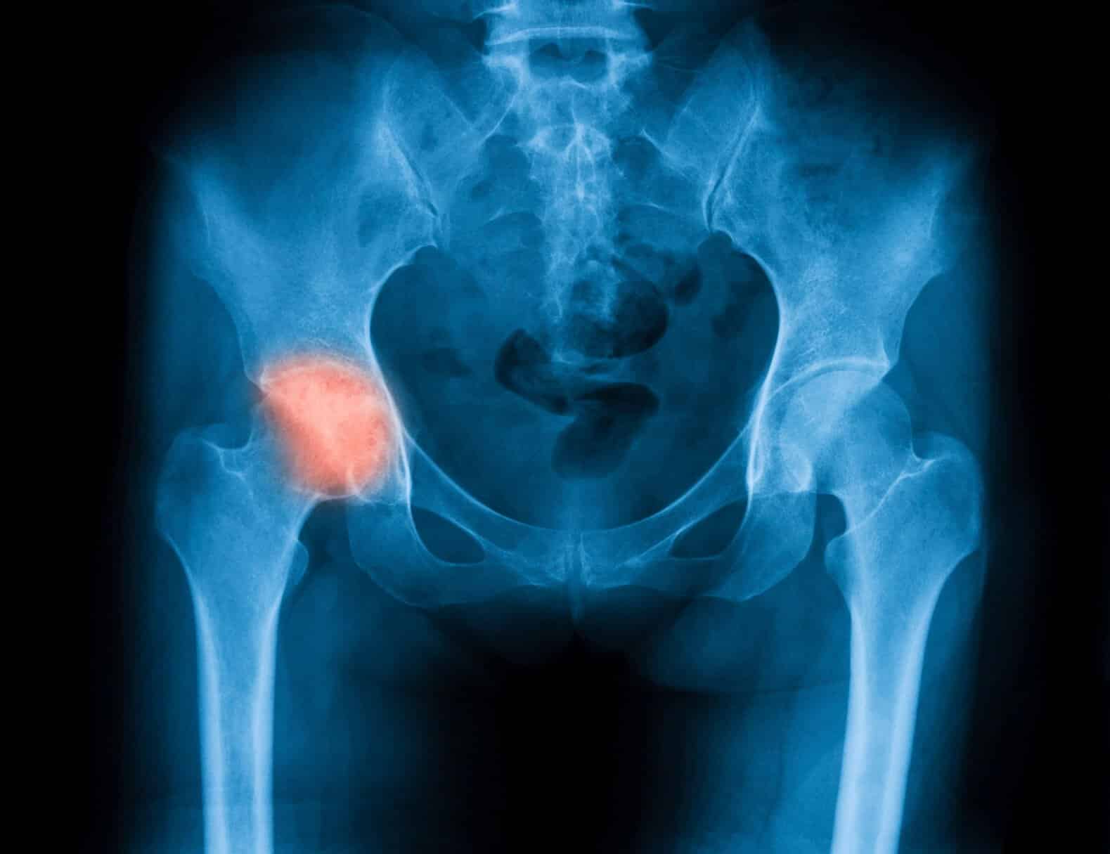 Joint Replacement, Alexander McLawhorn