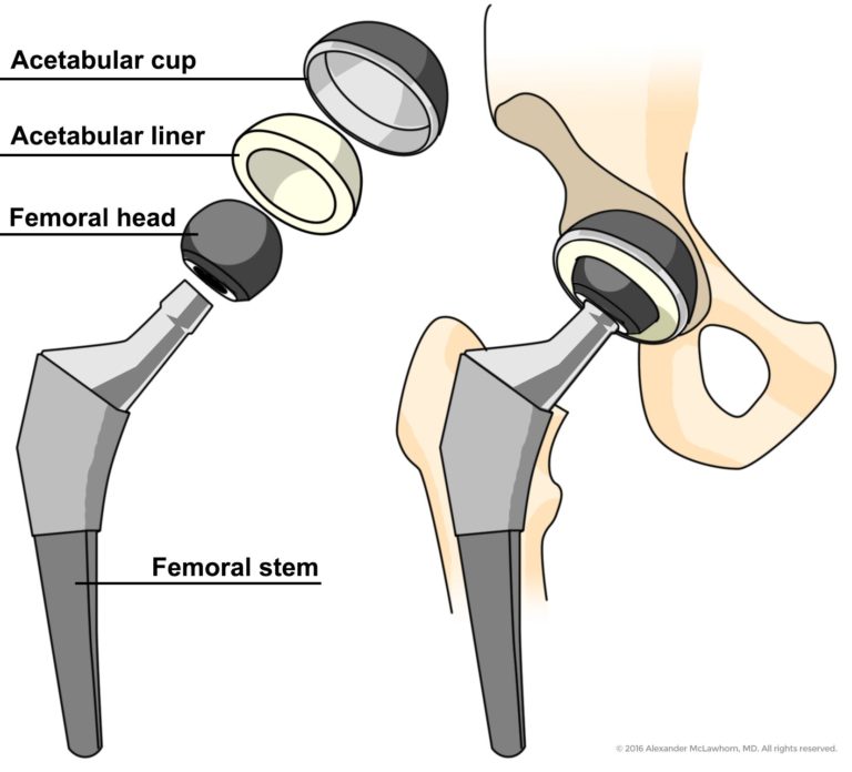 Total Hip Replacement New York - Hip Replacement Surgery Stamford