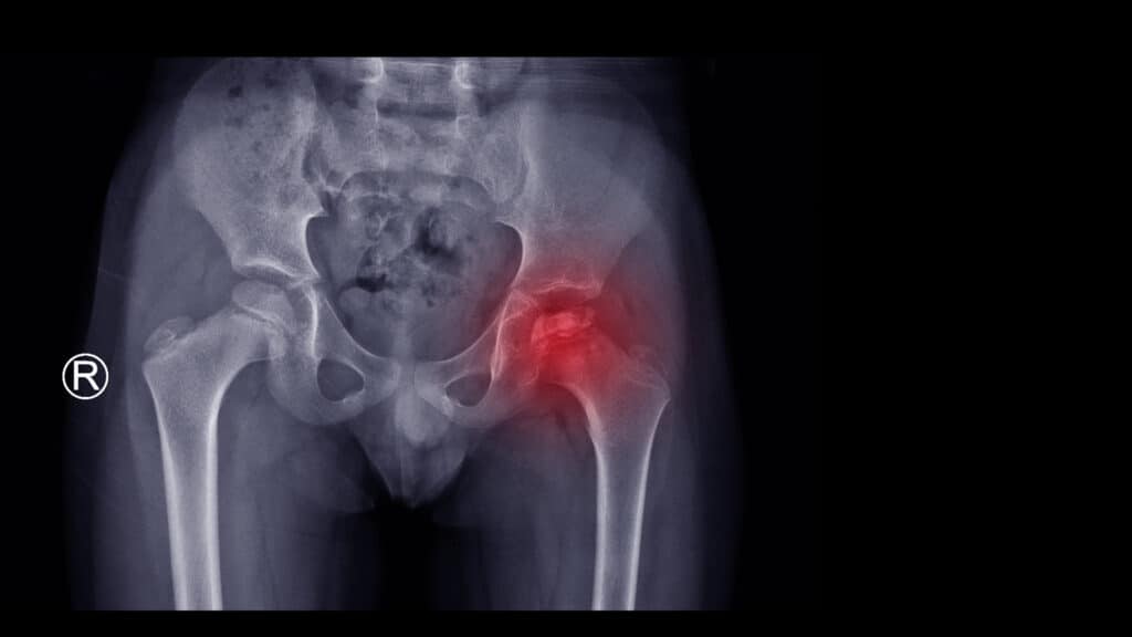 An X-ray of a child experiencing childhood hip necrosis